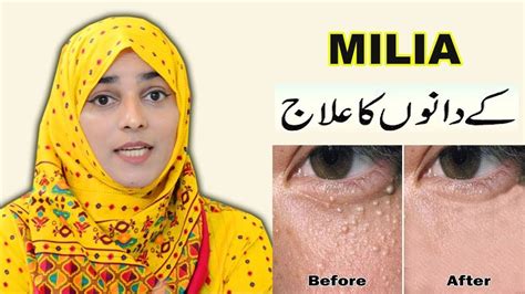 3 Remedies For Milia Removal At Home Youtube