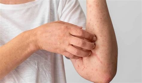 6 Tipos De Alergia Na Pele Causas E Tratamento Alergia Botafogo