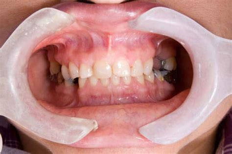 Oral And Maxillofacial Pathology Houston Tx Oral Pathologist Near Me