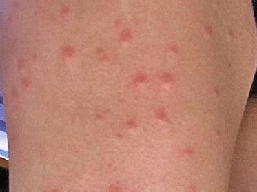 The more invasive the treatment you receive, and the longer it is performed, the longer recovery is likely to take. Sand Fly Bites Treatment, Pictures, Symptoms, Healing Time ...