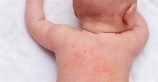 Heat Rash On Baby - Causes And Treatment | BellyBelly