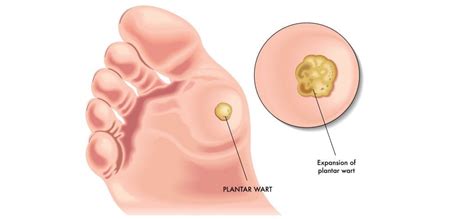 This topic has information about warts warts come in a wide range of shapes and sizes. Plantar Wart Causes, Symptoms & Treatments - Kill Foot Warts