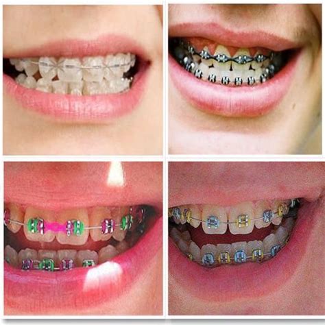 Review Of How To Make Fake Braces 2022 Newsise