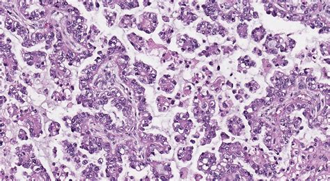 Pathology Outlines Clear Cell Carcinoma