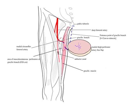 Sport and exercise physiotherapy online course: Medial Circumflex Femoral Artery Perforator Flap in a ...