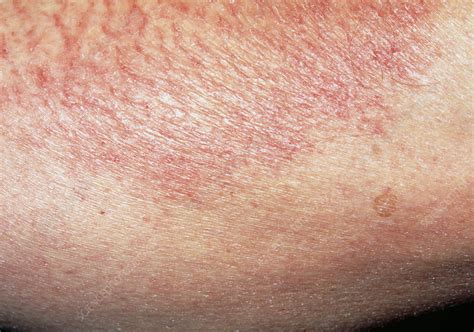 Close Up Of Patch Of Asteatotic Eczema On Skin Stock Image M150