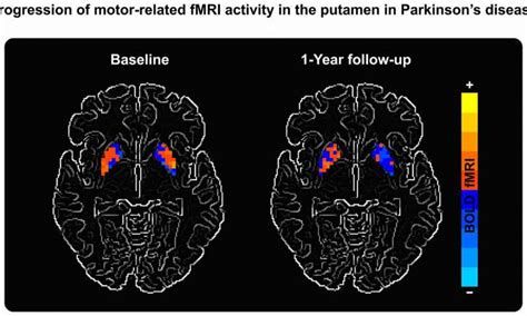 Mri Scans Showing Parkinsons Impact May Aid In Therapy