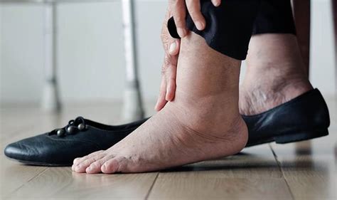 How To Stop Feet And Ankles Swelling In Hot Weather 7 Steps To Prevent ‘trapped Fluid