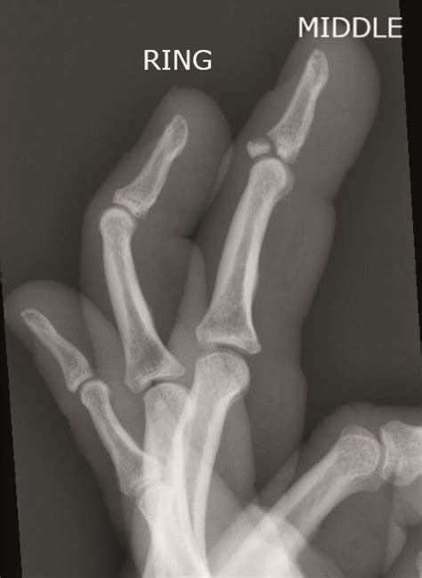 An Unlucky “double Blow” To The Fingers The Bmj
