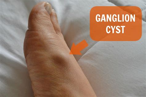 Podiatrist Her Ganglion Cyst Crimson Foot Care