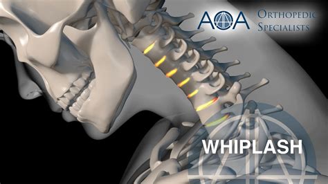 Aoa Orthopedic Specialists Whiplash Youtube