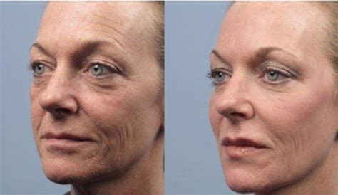 A Safe And Effective Best Skin Tightening Treatment Show Me The Spending