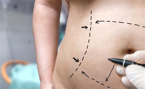 Belly Button Reshaping On The Rise In The Plastic Surgery World The