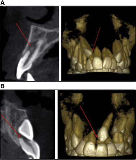 Predisposing Factors For Severe Incisor Root Resorption Associated With