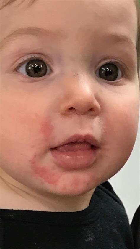 Red Rash On Childs Mouth Allergy Trigger