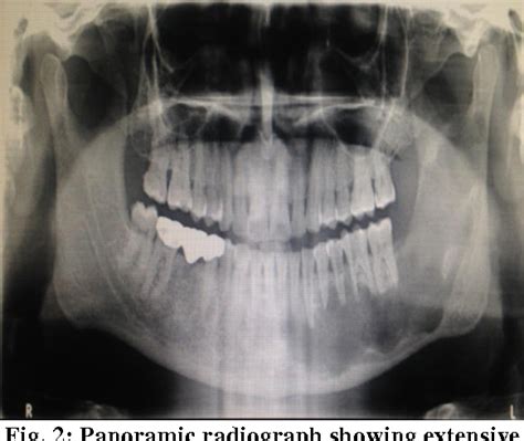 Figure 1 From A Case Report Of Aneurysmal Bone Cyst Of The Mandible
