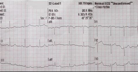 Dr Smiths Ecg Blog 30 Yo Woman With Chest Pain And A Normal Ecg By