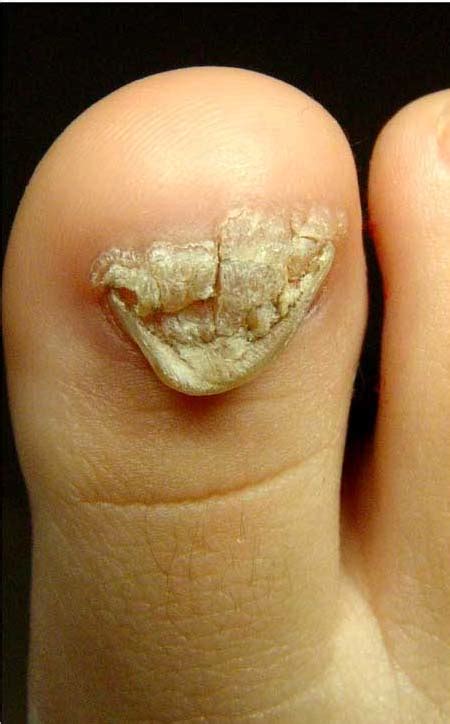 Subungual Wart The Foot And Ankle Online Journal