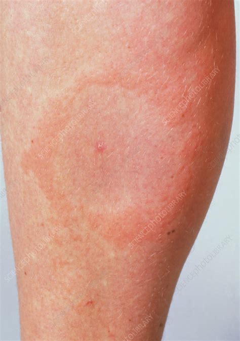 Lyme Disease Rash Looks Like