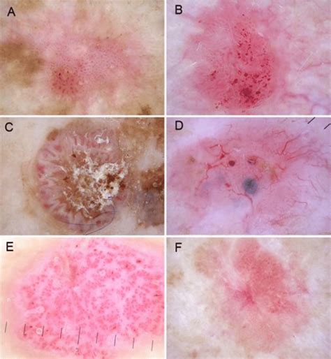 Dermatoscopy Of Unpigmented Lesions Of The Skin A New Classification