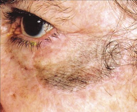 Severe Darkening Of A Facial Skin Graft From Latanoprost Surgery