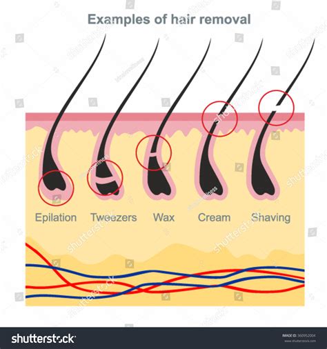 Sugar waxing, probably the first wax invented, started in the middle east and used a cooked sugar and lemon mixture to exfoliate the hair off the skin. Examples Of Hair Removal: Waxing, Shaving, Tweezers ...