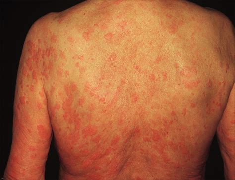 Pruritic Urticarial Skin Lesions Quiz Case Allergy And Clinical Immunology JAMA Dermatology