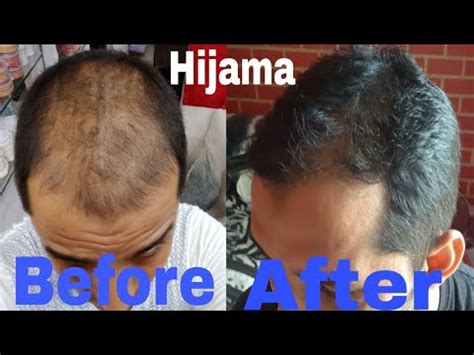 There are many reasons why excessive hair loss occurs in both men and women. Hair fall Baldness Ganjapan(बालों का टूटना) treatment by ...