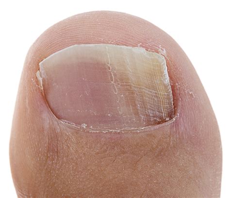 Toenail Fungus Picture And Photo Gallery Podiatrists And Foot Doctors