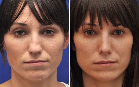 Rhinoplasty Before And After Photos Annapolis Md Nose Job
