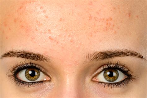 Home Remedies For Painless Bumps On The Forehead