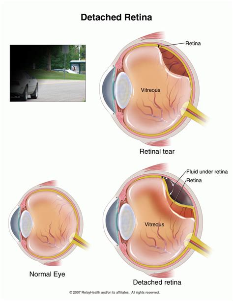 Check spelling or type a new query. Retinal detachment repair. Causes, symptoms, treatment ...