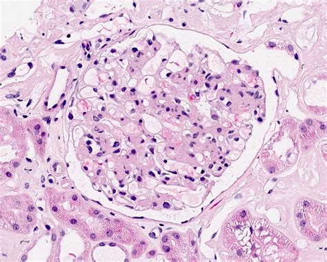 Pathology Outlines Renal Amyloidosis