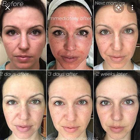 Microneedling Before And After 1 Treatment What Can 1 Session Do