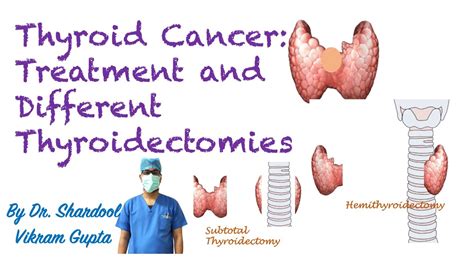 Thyroid Cancer Treatment And Different Types Of Thyroidectomy Youtube