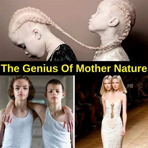 40 Genetic Mutations That Caused Some Seriously Unique Features Genetics People Hair Whorl