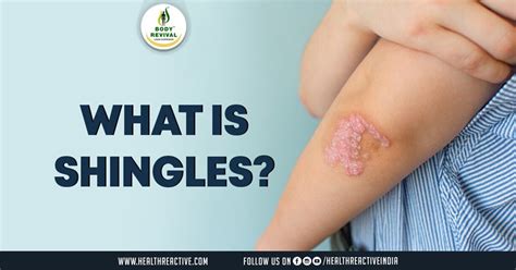 Understanding Shingles Causes Symptoms And Treatment Health