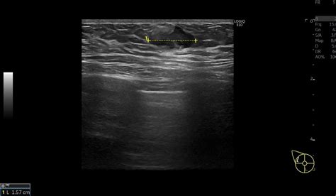 Breast Metastases From Malignant Melanoma With Unusual Ultrasound