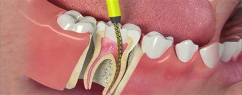 Dein zahnarzt untersucht den schmerzenden zahn und macht röntgenbilder, um seine vermutungen zu bestätigen. Wurzelbehandlung Zahnnerv Nerv Zahn Wurzel Zahnschmerz ...