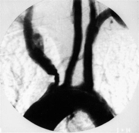 Feasibility Of Intraoperative Balloon Angioplasty And Additional Stent