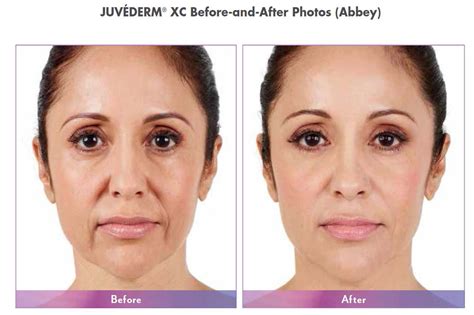 What Is Juvederm Treatment About Juvederm Juvederm Crawley Botox Clinic
