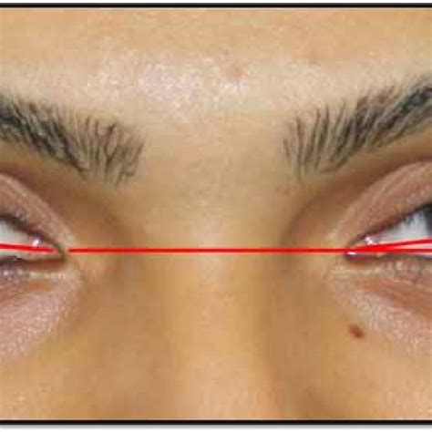 Palpebral Fissure Measurements PFW Distance Between The Medial And