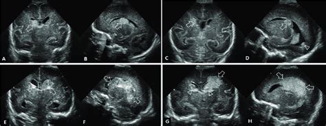 Ultrasound Findings Of Germinal Matrix Intraventricular Hemorrhage