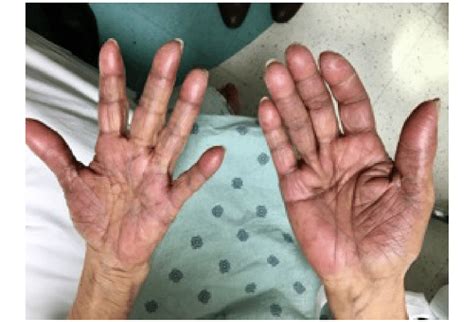 Erythema Swelling And Desquamation Of The Palmar Surfaces Download