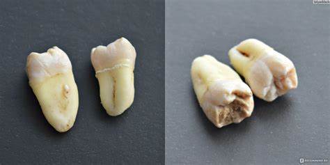 Диета при удаление зубов мудрости Удаление зубов - «Сложный случай - 20550 рублей потрачено, и 3 зуба Удаление зубов - «Сложный случай - 20550 рублей потрачено, и 3 зуба Диета при удаление зубов мудрости