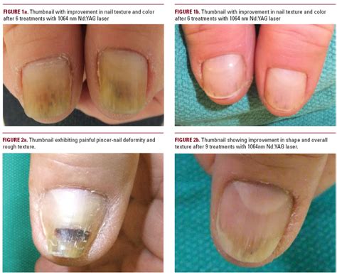 Pincer Nails Treatment Nail Ftempo