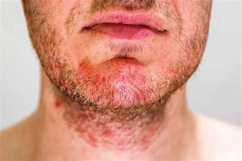 Dermatitis Seborreica Caracter Sticas Evoluci N Y Tratamiento Im