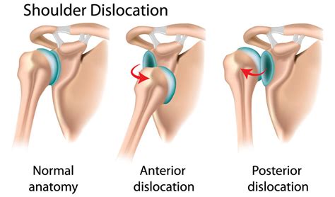 The center effectively treats the problems of the knee, hip, shoulder and elbow joints, performs operations on the spine, treats hand injuries and also helps with sports injuries. Sports Overuse | Singapore Sports and Orthopaedic Clinic