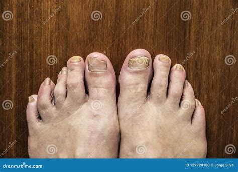 Psoriasis In The Foot Stock Photo Image Of Ugly Dermatitis 129728100