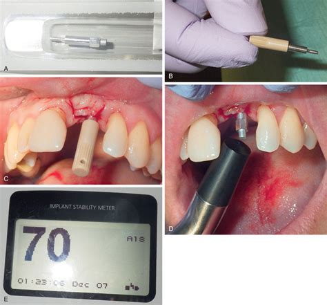 Periodontal And Maintenance Complications Pocket Dentistry